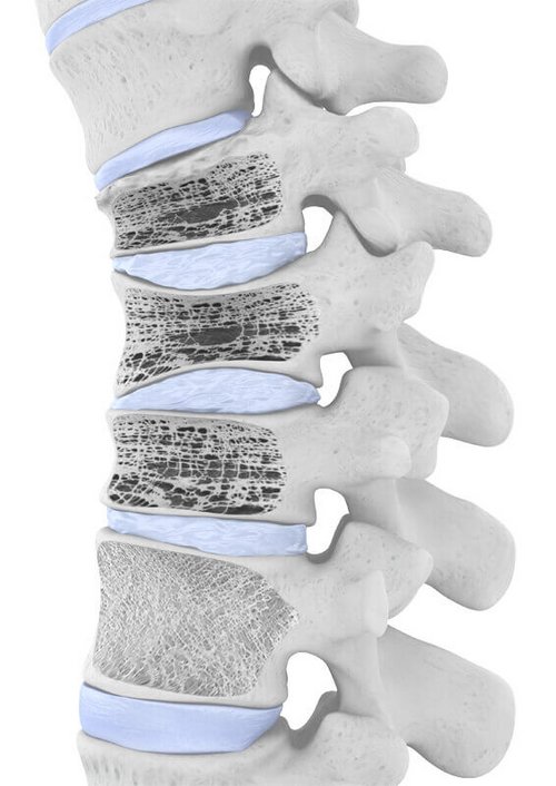 Darstellung der Anatomie der Wirbelsäule bei Osteoporose. Bei dieser Erkrankung vermindert sich die Knochendichte auffällig stark. Dies führt dazu, dass die Knochen zunehmend porös und instabil werden und deshalb schon beim geringsten Anlass brechen können. Besonders häufig geschieht dies an den Wirbelkörpern der Wirbelsäule, was zu heftigen, plötzlich einsetzenden Schmerzen führt und mitunter jede weitere Bewegung unmöglich macht.